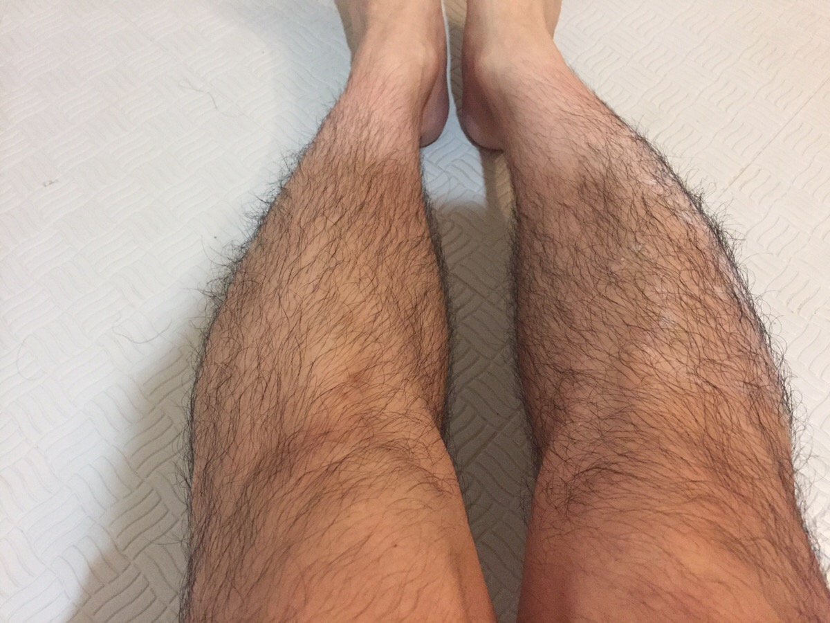 脚の様子(before)