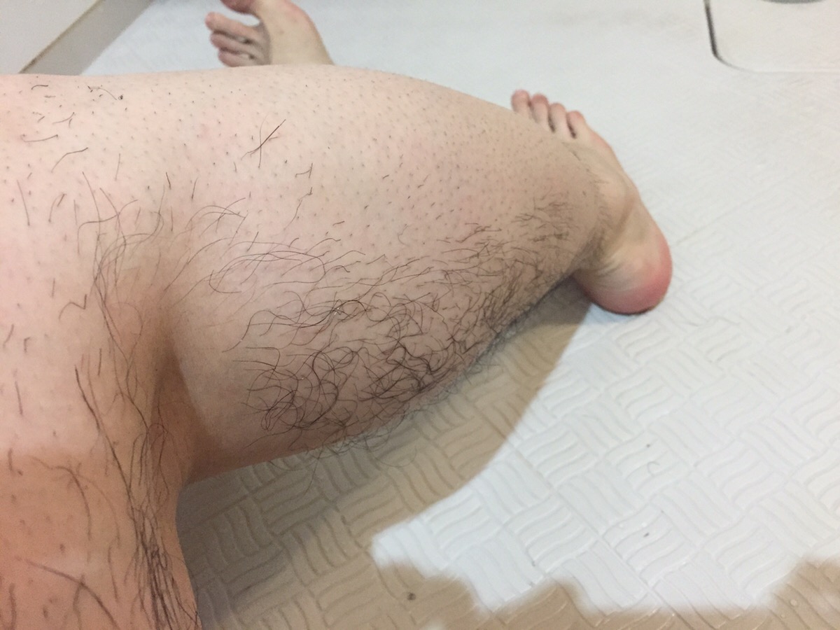 除毛スプレー失敗例