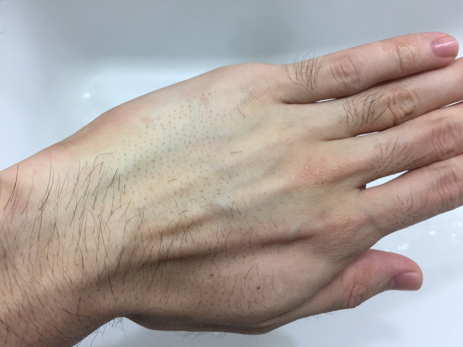 手の甲でパッチテストを行った様子